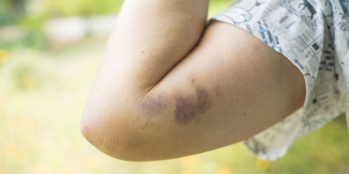When to Seek Medical Attention for Unexplained Bruising