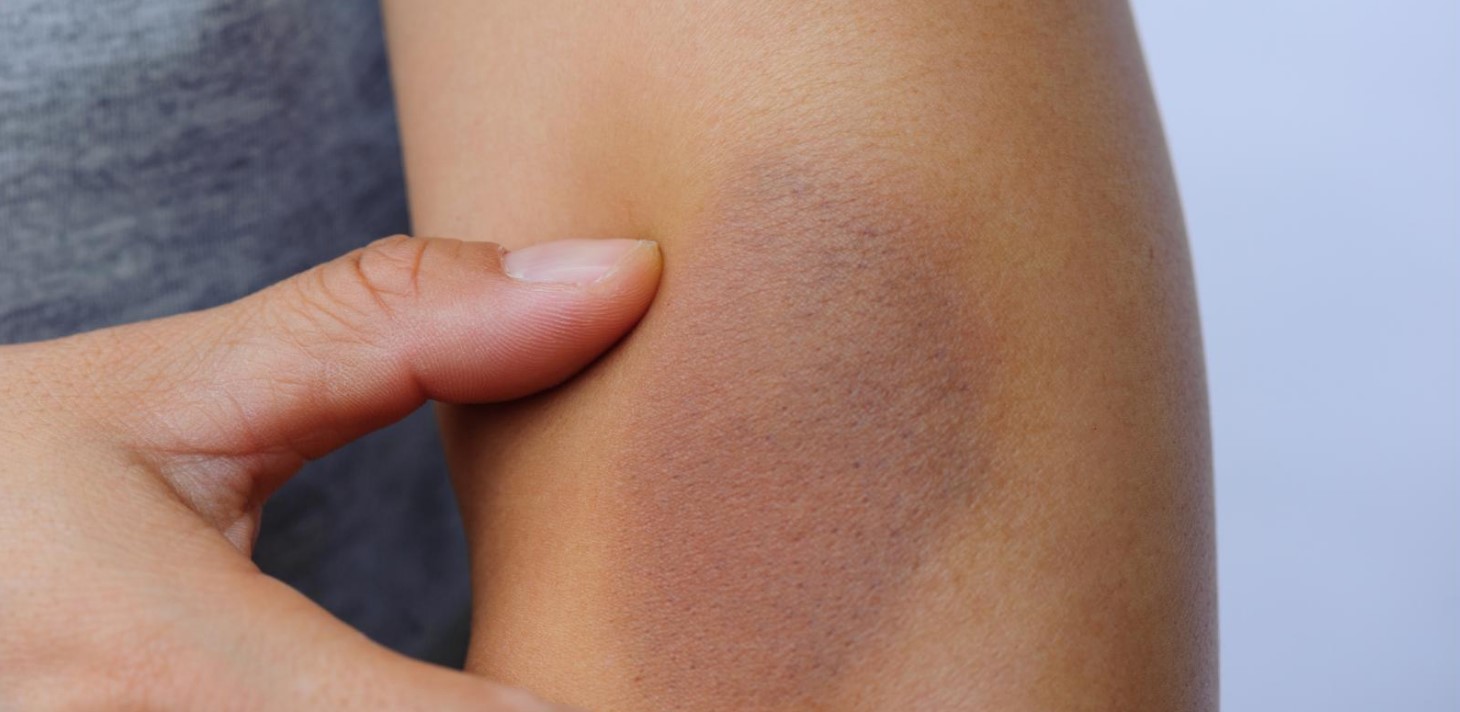 Treatment Options for Unexplained Bruising
