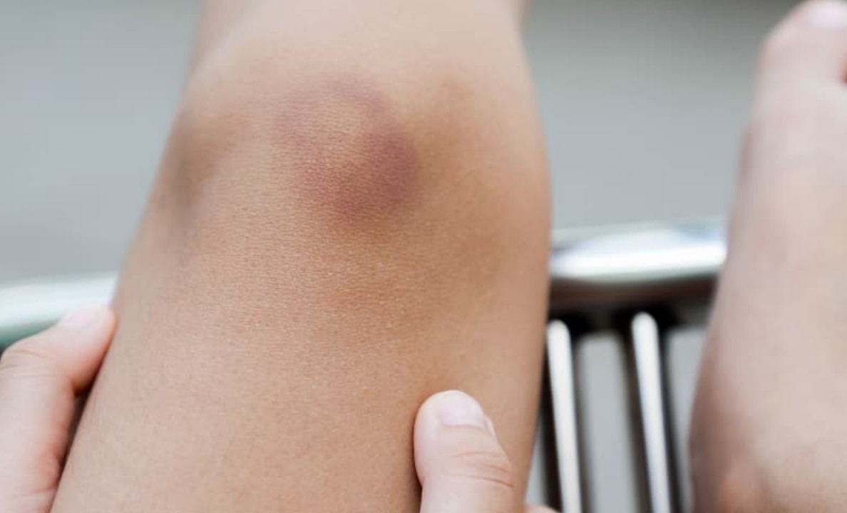 Natural Remedies for Unexplained Bruising