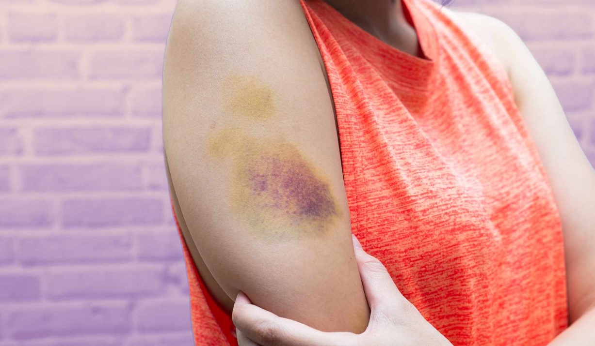 Causes of Unexplained Bruising