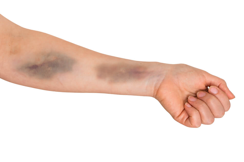 Understanding Unexplained Bruising