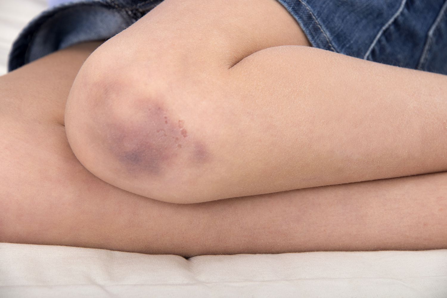 Diagnosing Unexplained Bruising